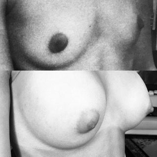 augmentation mammaire: les implants siconés récents durent beaucoup plus longtemps!!